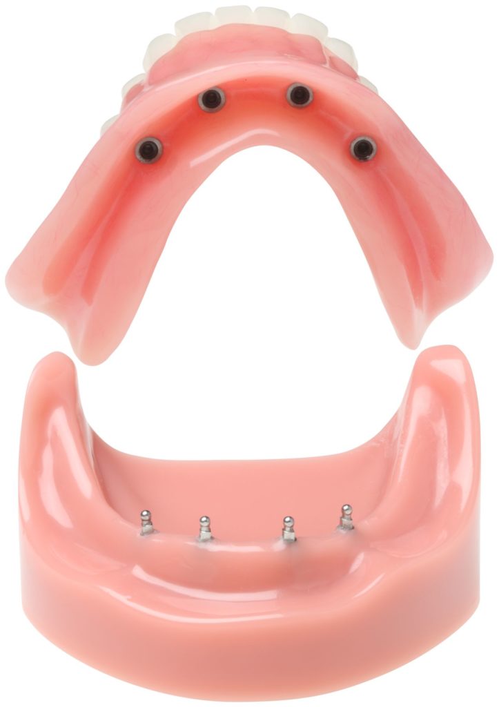 3M ESPE Mini-Implantate Modell